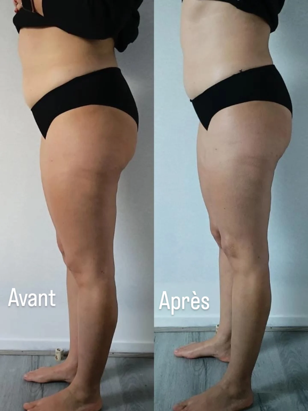 Après - Lifting colombien